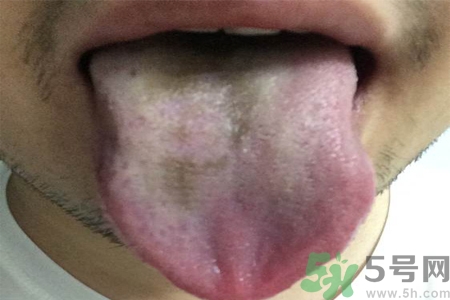 舌頭發(fā)黑怎么回事？舌頭發(fā)黑怎么辦？