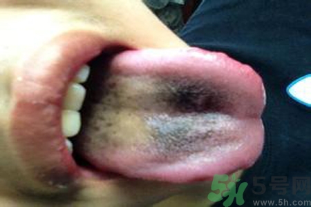 舌頭發(fā)黑怎么回事？舌頭發(fā)黑怎么辦？