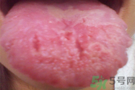 舌頭上有裂紋是怎么辦？舌頭上有裂紋是什么原因？