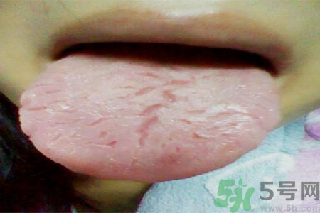 舌頭上有裂紋是怎么辦？舌頭上有裂紋是什么原因？