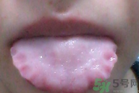 舌頭上有齒痕怎么回事？舌頭上有齒痕怎么辦？