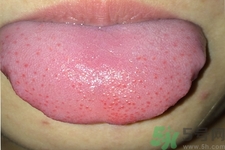 舌頭上有齒痕怎么回事？舌頭上有齒痕怎么辦？