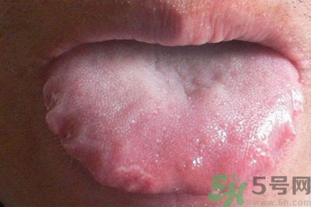 舌頭上有齒痕怎么回事？舌頭上有齒痕怎么辦？