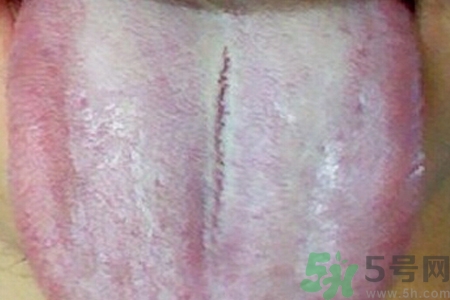 舌頭發(fā)白是什么原因？舌苔發(fā)白是怎么辦？