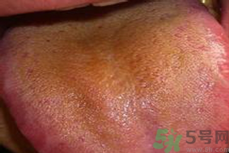 舌苔厚黃是怎么回事？舌頭發(fā)黃怎么辦？