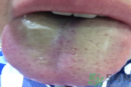 舌苔厚黃是怎么回事？舌頭發(fā)黃怎么辦？