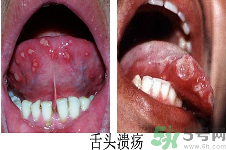 舌頭潰瘍?cè)趺崔k？舌頭潰瘍的原因？
