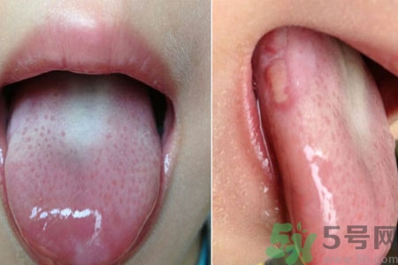 舌頭潰瘍?cè)趺崔k？舌頭潰瘍的原因？