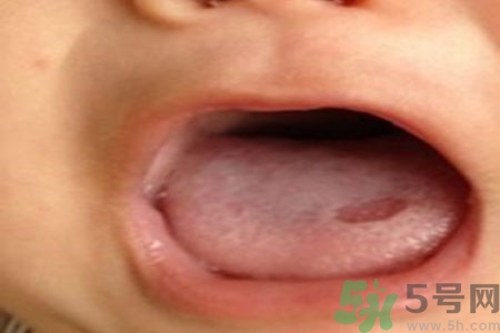 舌頭潰瘍?cè)趺崔k？舌頭潰瘍的原因？