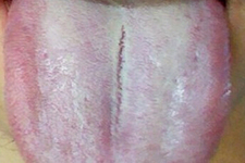 舌頭發(fā)白是什么原因？舌苔發(fā)白是怎么辦？