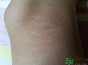 肥胖紋能去掉嗎？ 肥胖紋瘦了以后會(huì)消失嗎？