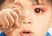 寶寶得了紅眼病怎么辦？寶寶得了紅眼病怎么治？