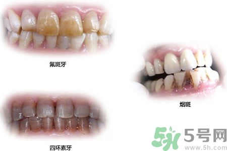 四環(huán)素牙是什么？四環(huán)素牙是怎么形成的？