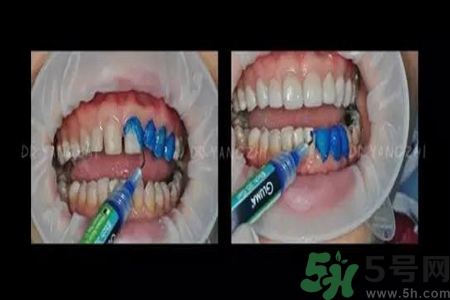 四環(huán)素牙是什么？四環(huán)素牙是怎么形成的？