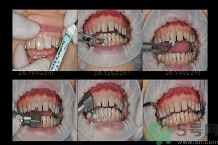 四環(huán)素牙是什么？四環(huán)素牙是怎么形成的？