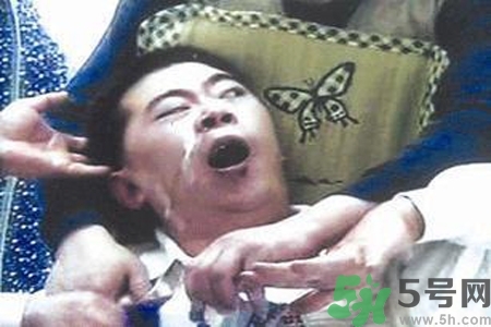 癲癇的典型癥狀有哪些？癲癇是什么？