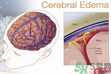 癲癇的發(fā)病因素？癲癇的并發(fā)癥有哪些？