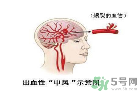 腦中風(fēng)的護(hù)理措施？腦中風(fēng)的飲食護(hù)理？