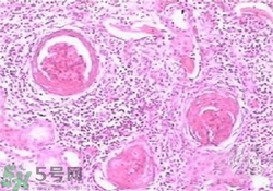 慢性腎炎能治好嗎？慢性腎炎能活多久？