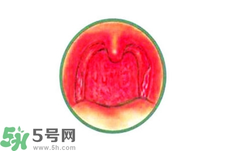 慢性咽炎的治療方法？慢性咽炎的藥物治療？