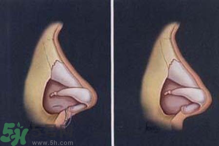 鼻竇炎的護(hù)理措施？鼻竇炎的飲食護(hù)理？