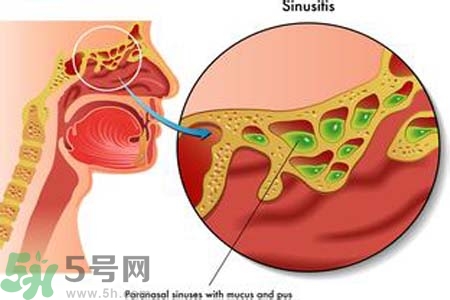 鼻竇炎的護(hù)理措施？鼻竇炎的飲食護(hù)理？