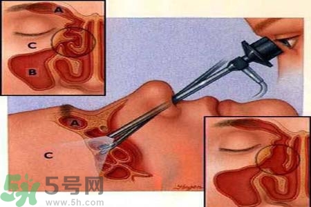 鼻竇炎的護(hù)理措施？鼻竇炎的飲食護(hù)理？