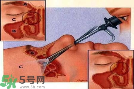 鼻竇炎的高發(fā)人群？如何預(yù)防鼻竇炎？