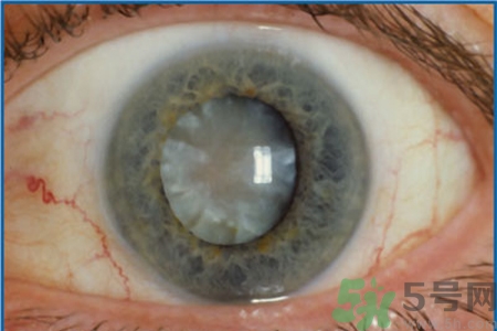 白內(nèi)障治療方法是什么？白內(nèi)障可以用什么藥物治療？