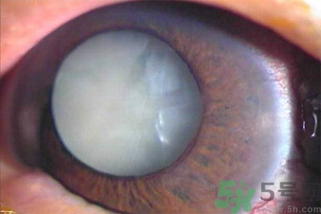 白內(nèi)障治療方法是什么？白內(nèi)障可以用什么藥物治療？