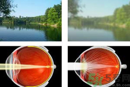 白內(nèi)障的高發(fā)人群有哪些？如何預(yù)防白內(nèi)障？