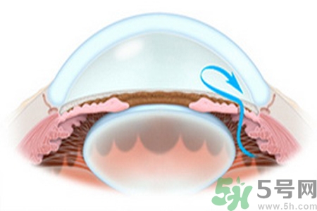 青光眼是什么？青光眼癥狀有什么？