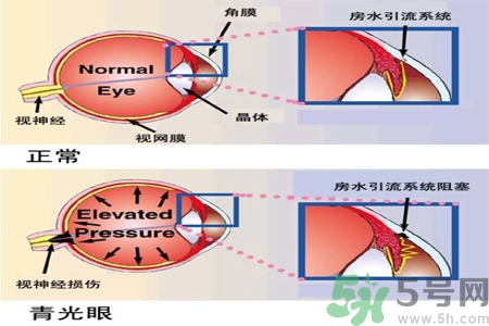 青光眼的護(hù)理措施有什么？青光眼的飲食護(hù)理有哪些？