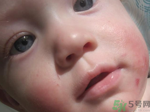 寶寶長奶蘚怎么回事？寶寶長奶蘚怎么辦？
