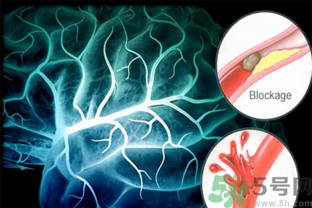 腦出血的發(fā)病因素是什么？腦出血的并發(fā)癥有哪些？