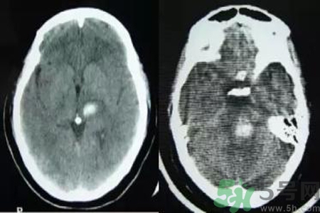 腦出血的發(fā)病因素是什么？腦出血的并發(fā)癥有哪些？