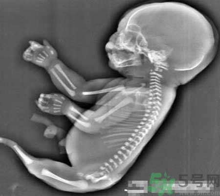 媽媽懷上人魚寶寶 什么是美人魚綜合癥？