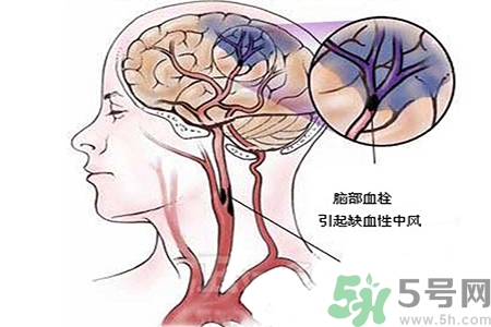 腦出血的治療方法是什么？腦出血可以用哪些藥物治療？