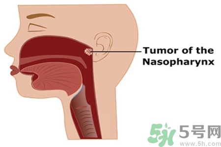 鼻咽癌的日常措施是什么？鼻咽癌注意的飲食有哪些？