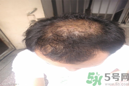 脫發(fā)的措施有什么？脫發(fā)的注意飲食有哪些？