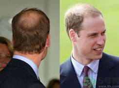 男人禿頂是什么原因？男人禿頂怎么辦？