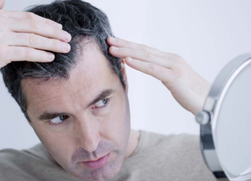 男人禿頂能治好嗎？治療禿頂小偏方