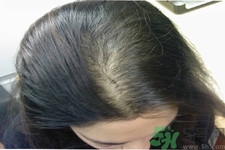 脫發(fā)的治療方法是什么？脫發(fā)的藥物治療有哪些？