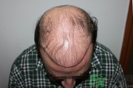 脫發(fā)的治療方法是什么？脫發(fā)的藥物治療有哪些？