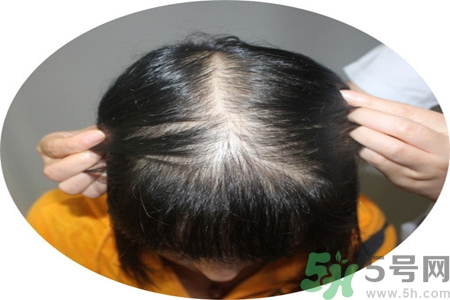 脫發(fā)的治療方法是什么？脫發(fā)的藥物治療有哪些？