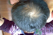 脫發(fā)的高發(fā)人群有哪些？如何預防脫發(fā)？