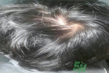 脫發(fā)的高發(fā)人群有哪些？如何預防脫發(fā)？