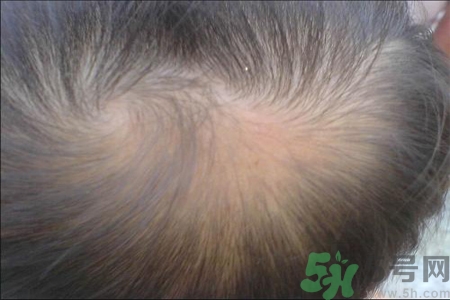 脫發(fā)的高發(fā)人群有哪些？如何預防脫發(fā)？