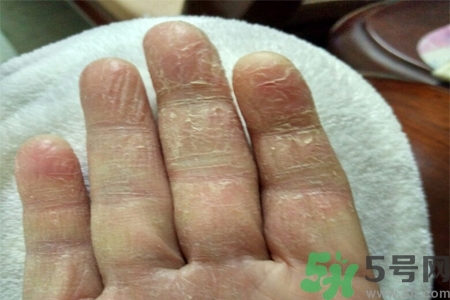 手足癬是什么？手足癬癥狀有什么？