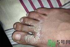 手足癬是什么？手足癬癥狀有什么？